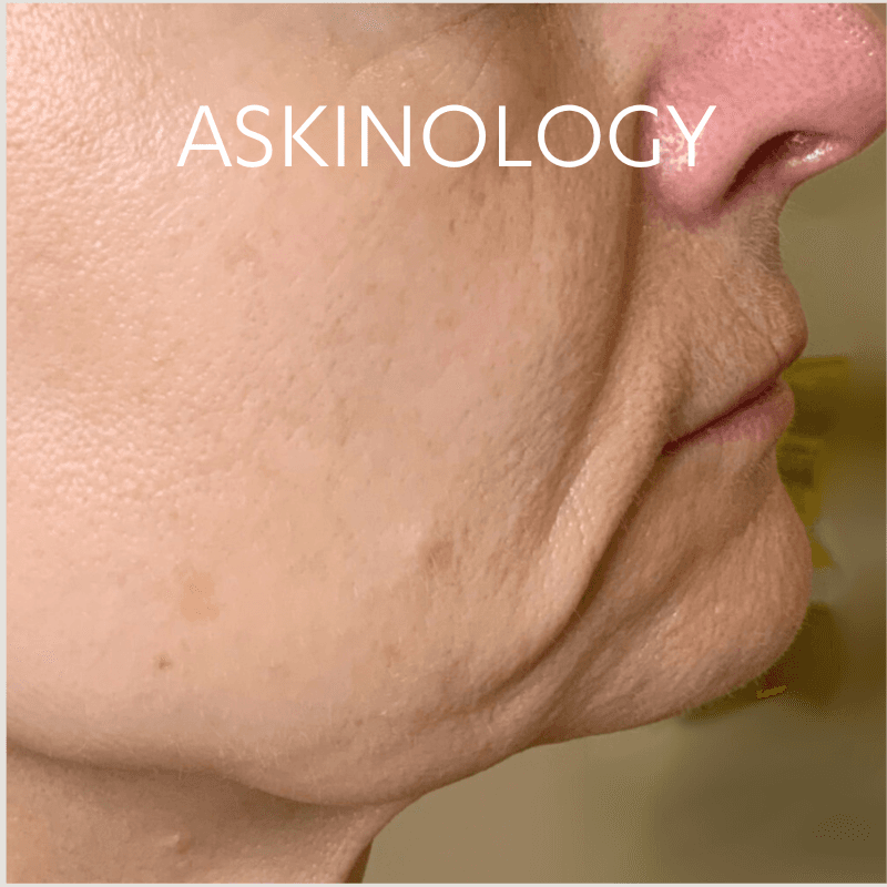 Secret RF treatment at askinology - after photo